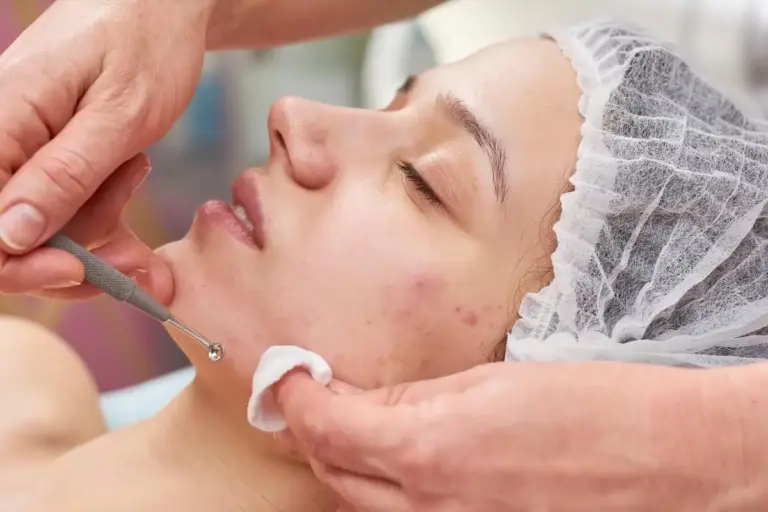 Acne-Treatment-by-Allure-Dermatology-in-Edinburg-TX