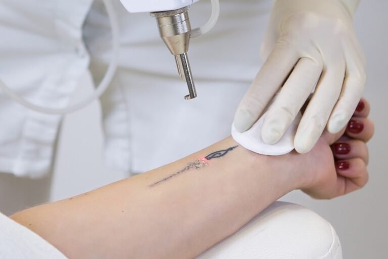 Close-up of laser tattoo removal from woman hand