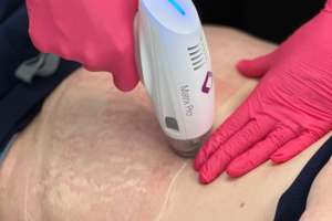 Radio Frequency Microneedling London for skin rejuvenation