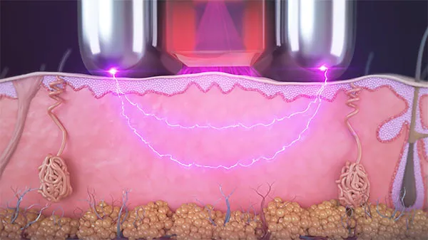 Non-Invasive Deep Skin Revitalization Using Candela Sublime-« (2)