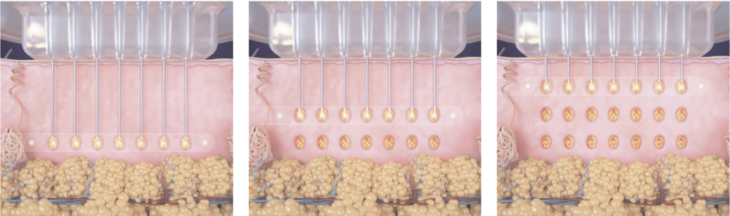 Collagen stimulation treatment with RF Microneedling