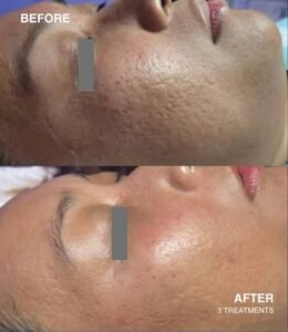 Acne scar treatment with RF Microneedling London