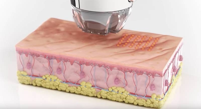 Radio Frequency Skin Resurfacing London