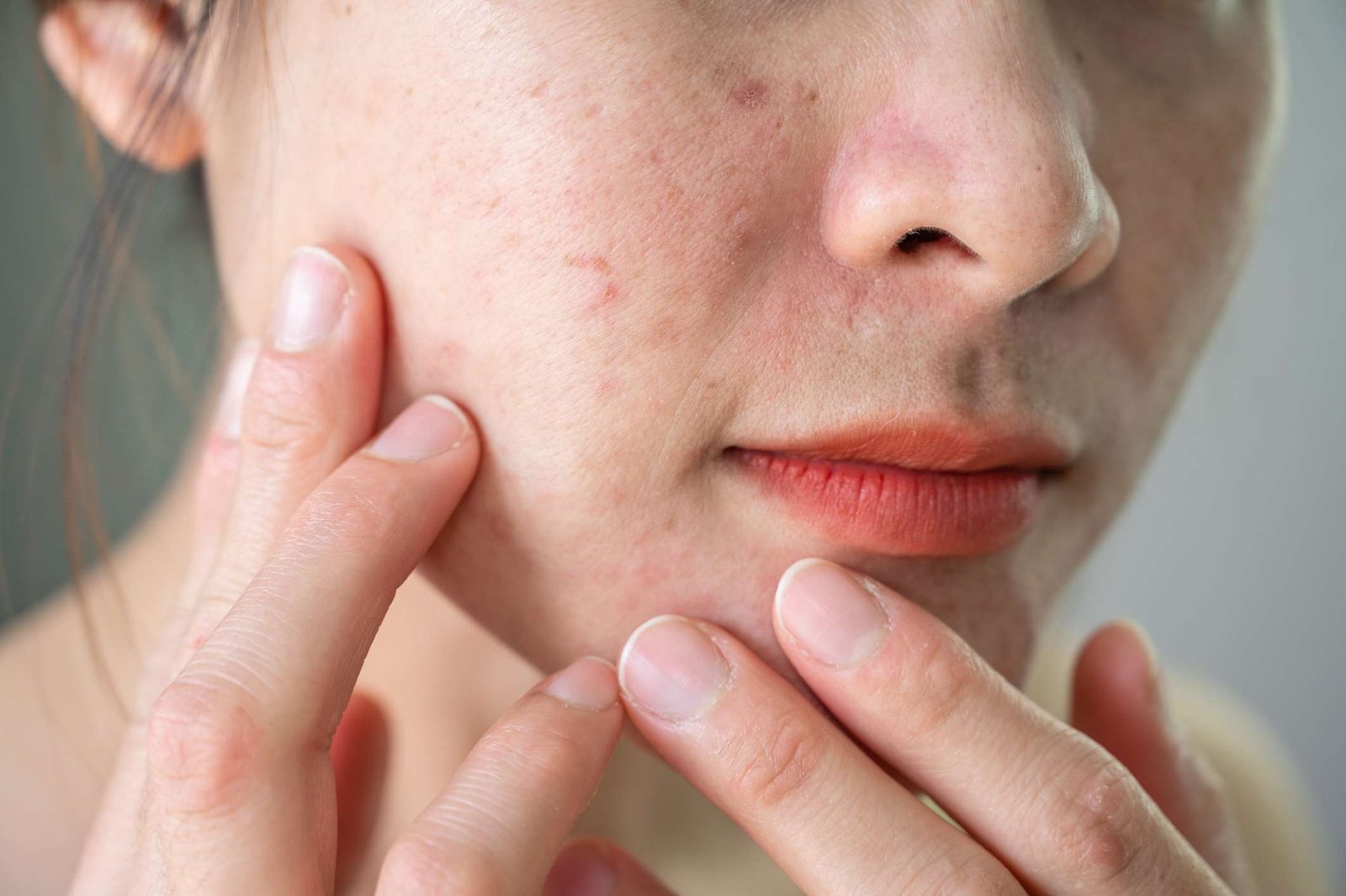 Acne scar treatment with RF Skin Resurfacing