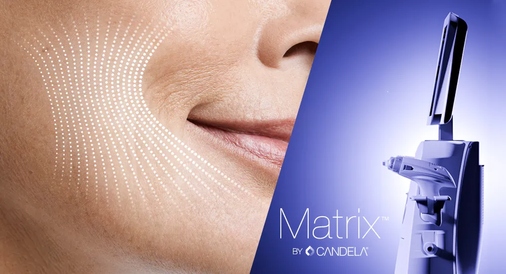 Candela Sublime™ RF and IR skin tightening treatment