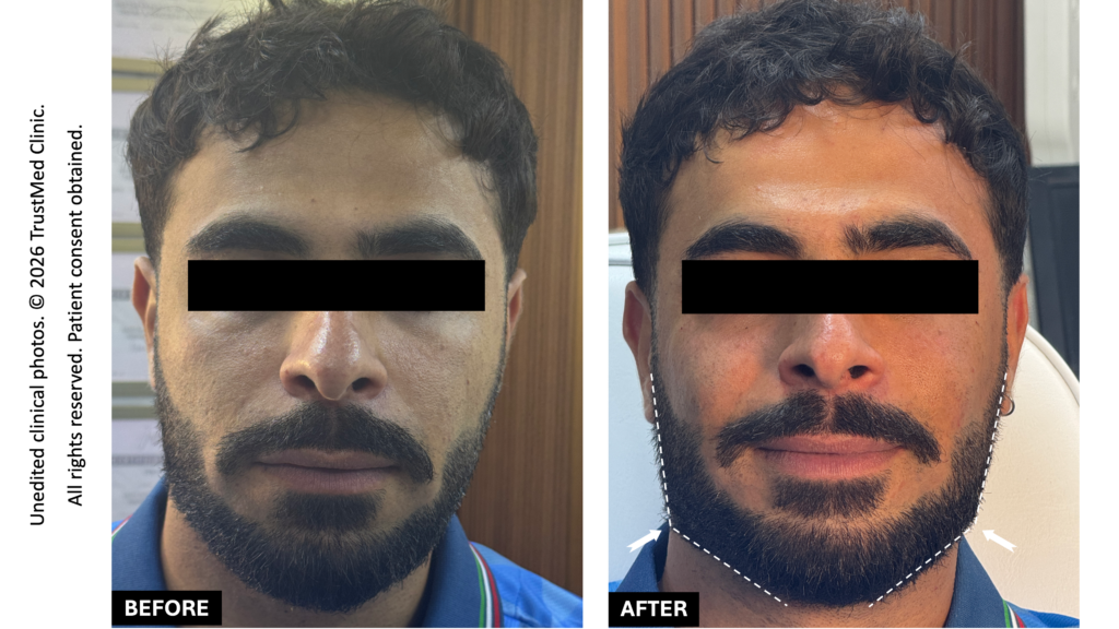 Jawline correction