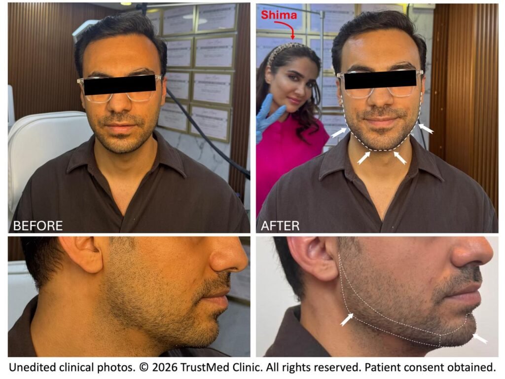 Natural looking jawline and chin definition