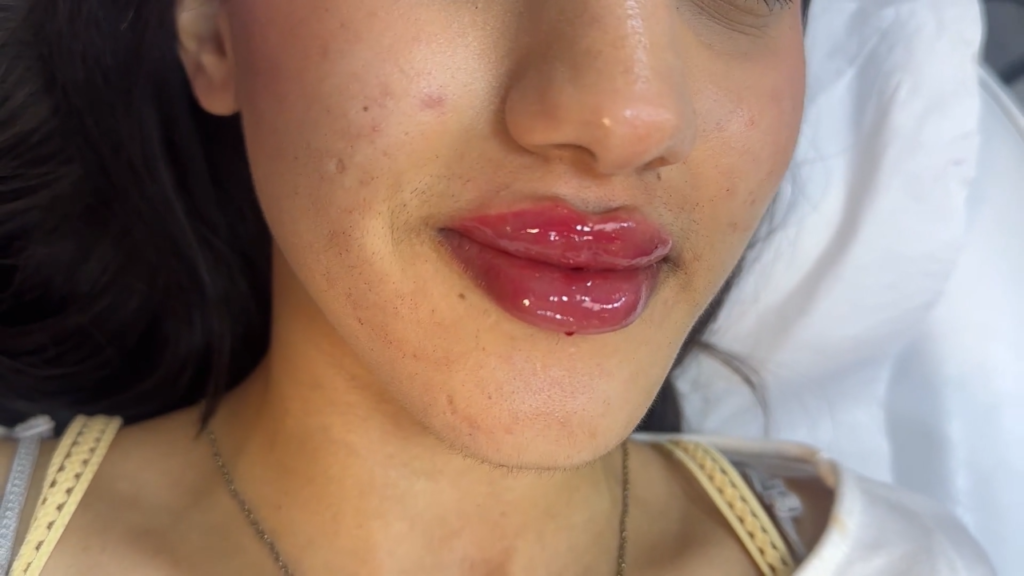 Russian lip enhancement