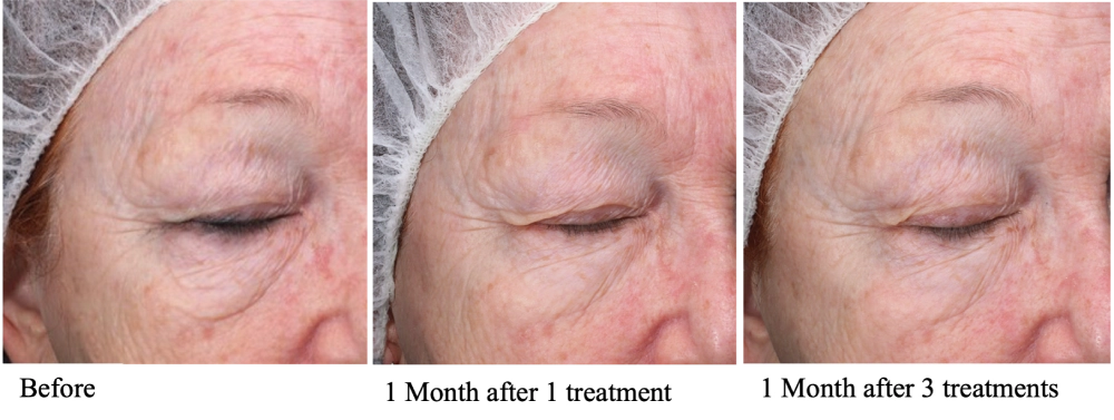 Festoons before and after a series of Matrix Pro RF microneedling treatments