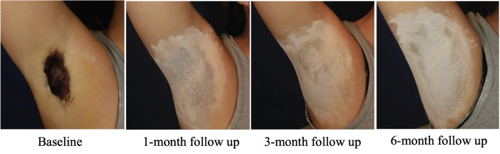 Starch iodine test before and after RF microneedling for axillary hyperhidrosis